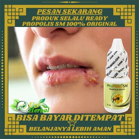 Jual Obat Herbal Herpes Oral Penyakit Herpes Di Bibir Herpes Di Mulut