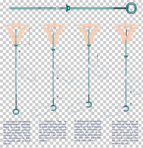 Intrauterine Device Uterus Copper Iuds Birth Control Pregnancy Png