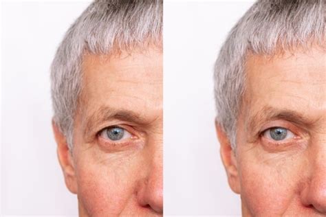 The Benefits Of Having An Eyelid Lift Procedure Paul C Dillon Md