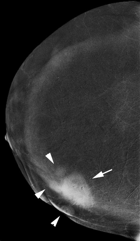 Multifocal Invasive Ductal Carcinoma In A Year Old Woman With Dense