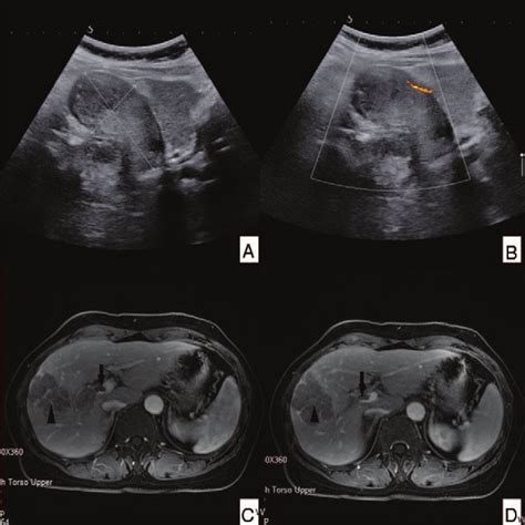 Abdominal Ultrasonography Us A And B And Contrast Enhanced Magnetic