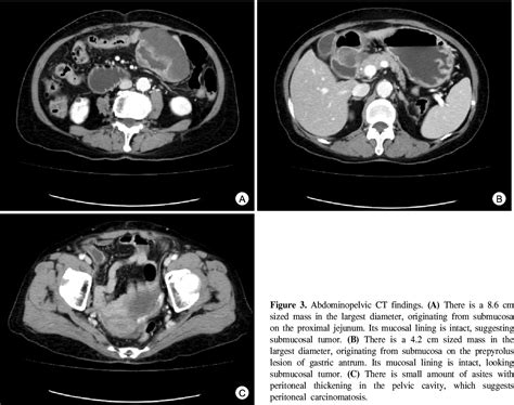 Figure 1 From A Patient With Jejunal Mucinous Adenocarcinoma Metastatic