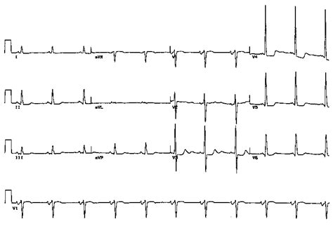 Left Ventricular And Left Atrial Hypertrophy