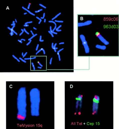 De Novo Terminal Deletion Of Chromosome 15q26 1 Characterised By Comparative Genomic