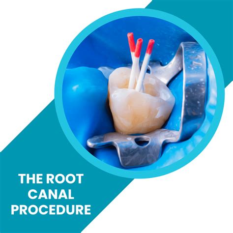 The Root Canal Procedure - How much is a root canal?