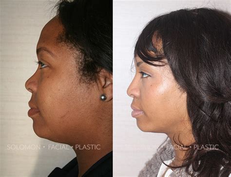 Black Rhinoplasty Before And After