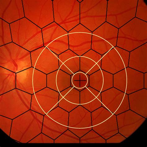 Time Domain Oct Scan Of A Healthy Macula A And The Corresponding