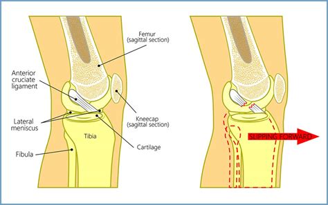 Anterior Cruciate Ligament Repair (ACL, MCL, MPFL, PCL, LCL ...