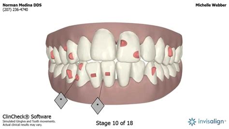 Invisalign Clincheck YouTube