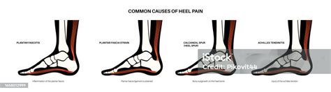 heel pain diagram stock illustration  image  achilles