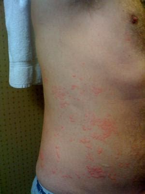 Skin Rash on Arms and Legs