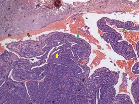 Hidradenoma Histology