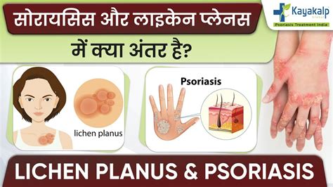 Psoriasis और Lichen Planus मैं क्या अंतर है Psoriasis Vs Lichen