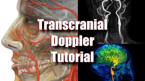 Transcranial Doppler Sonographic Tendencies