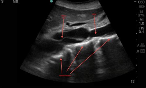 Ultrasound Images Aorta Emory School Of Medicine