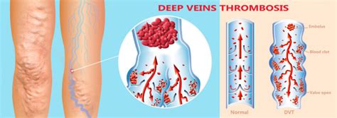 Varicose Veins Bleeding Richard Evans Vascular