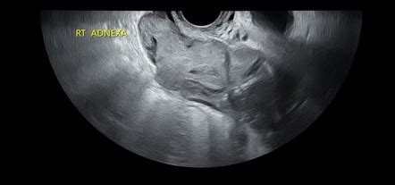 Ruptured Ectopic Pregnancy Radiology Case Radiopaedia Org