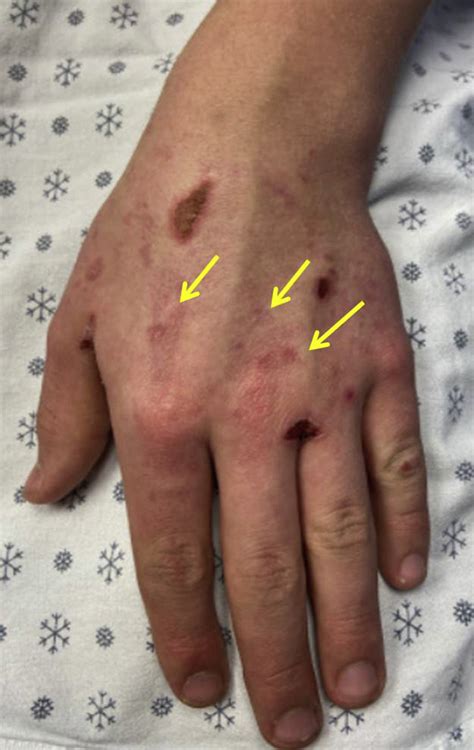 An Atypical Case Of Pediatric Epidermolysis Bullosa Acquisita Review Of Diagnosis And Pitfalls