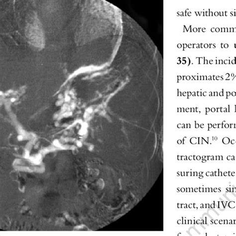 Left Lateral Decubitus Chest X Ray After The Administration Of