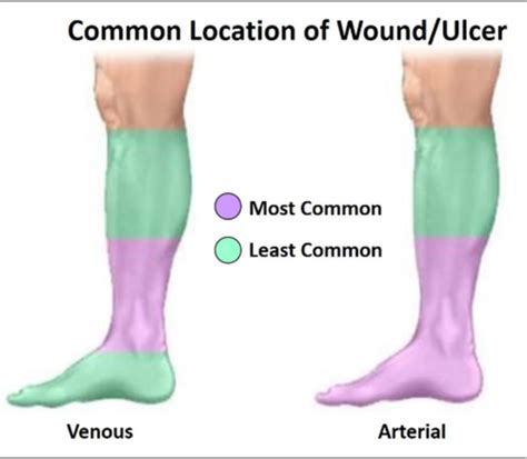 Vascular Disease Flashcards Quizlet