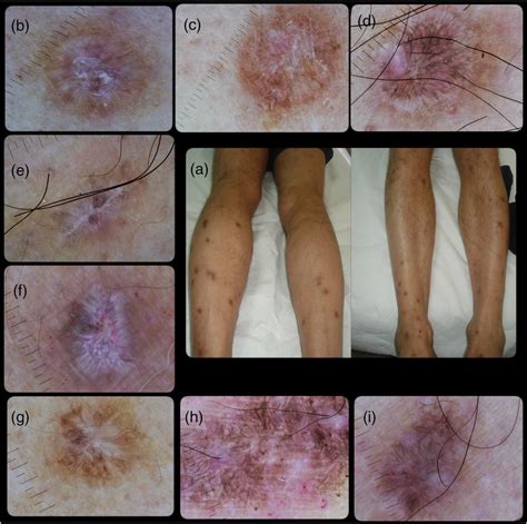 A Physical Examination Revealed Multiple Firm Download Scientific Diagram