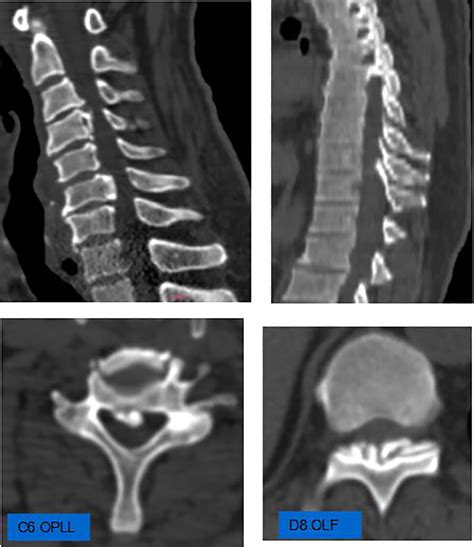 Ossification Of Posterior Longitudinal Ligament In Cervical Spine And Its Association With