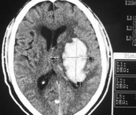 Intracerebral Hemorrhage Ct Scan