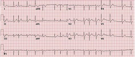 EKG Interpretation Part 2 Flashcards | Quizlet