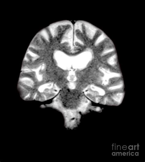 Mri Of Brain With Alzheimers Disease Photograph by Medical Body Scans