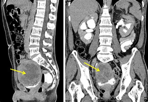 Squamous Cell Carcinoma Of Urinary Bladder Radiology Cases