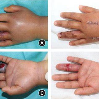 Intraoperative Finding Fasciotomy And Negative Pressure Wound Therapy