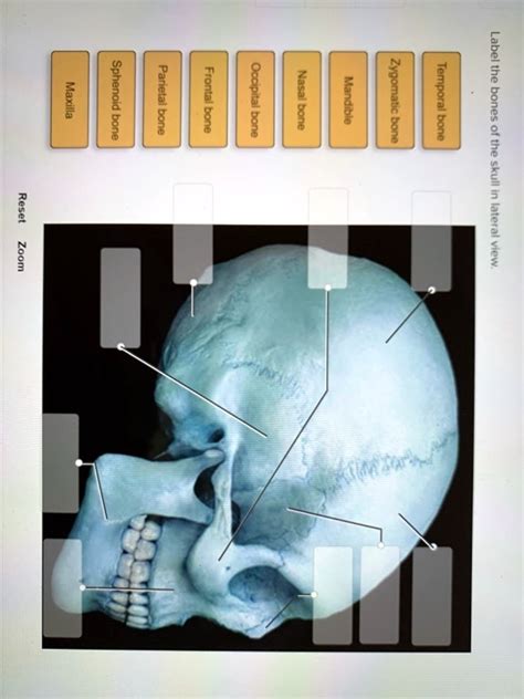 Solved Maxilla Sphenoid Bone Parietal Bone Frontal Bone Occipital