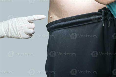 Skin tag or acrochondon or soft fibroma 35174951 Stock Photo at Vecteezy