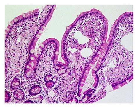 Whipples Disease Obvious Enlargement Of The Villi Filled By Foamy