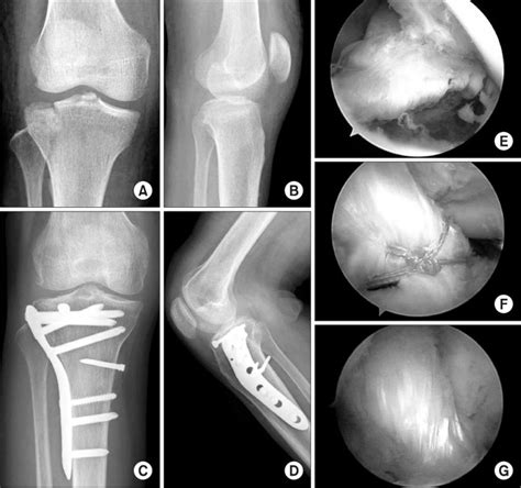 Arthroscopically Assisted Reduction And Internal Fixation Of Intra