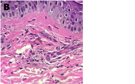 Vasculitis Leucocitocl Stica Tras La Vacuna Chadox S Ncov Hpc