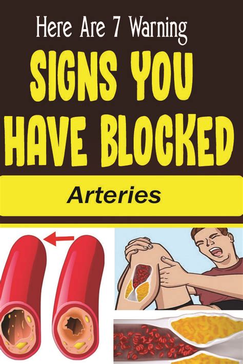 Here Are 5 Warning Signs You Have Blocked Arteries In 2020 Arteries