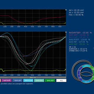 Lv Rotation And Twist Histogram For Epicardial And Endocardial Layers