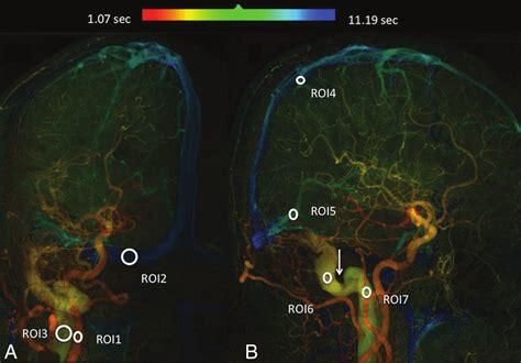 Quantitative Color Coded Digital Subtraction Angiography Of The