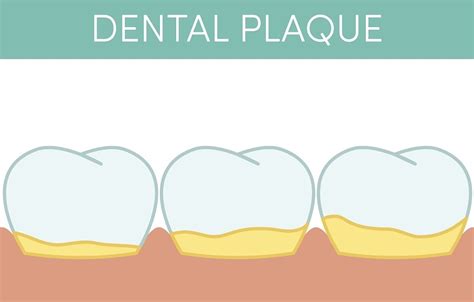 Protect Your Teeth from Dental Plaque - Smile Habits OC