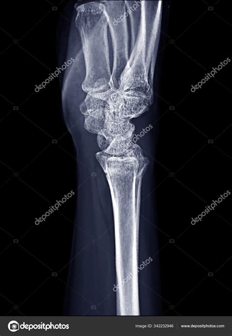 X Ray Wrist Lateral View