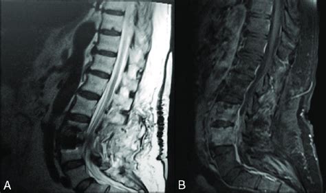 A And B Magnetic Resonance Imaging Of L3 L4 Vertebrae With Extensive