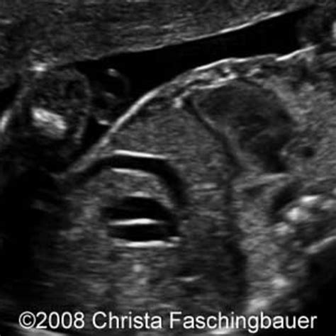 📃 Gallbladder Duplication