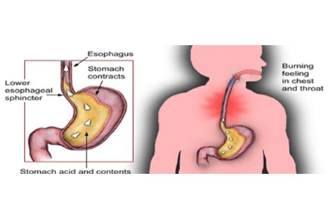 What Causes Belching