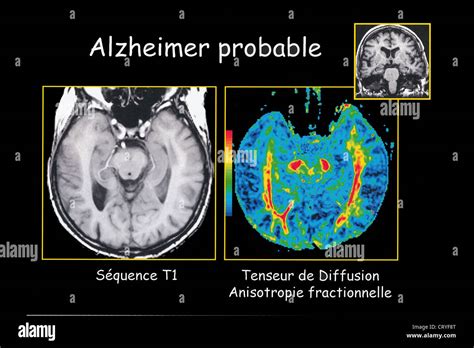 ALZHEIMER DISEASE, MRI Stock Photo: 49162536 - Alamy