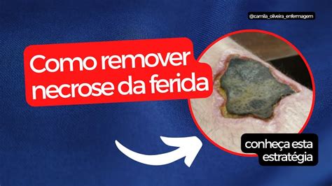 Ferida Com Necrose O Que Usar - Como remover a necrose coagulativa na ferida? - YouTube