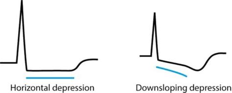 St Segment Depression In Myocardial Ischemia And Differential Diagnoses