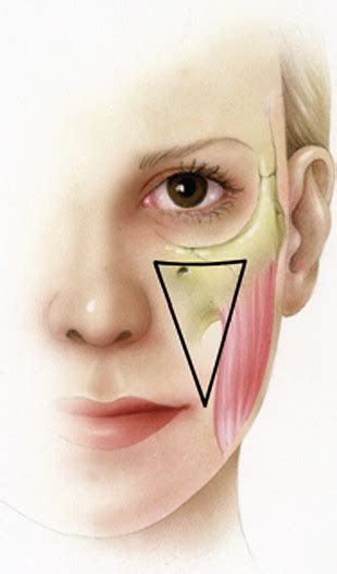 midface alloplastic augmentation   asian  latino patient