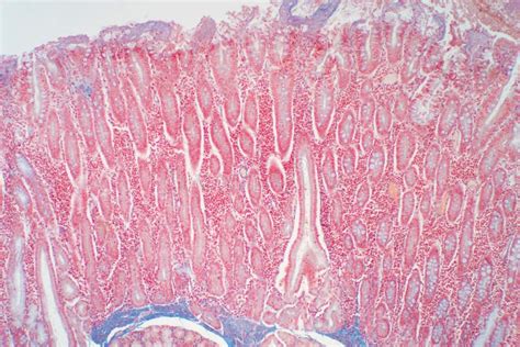 Duodenum Biopsy From The Pathology Of Small Intestine Stock Image