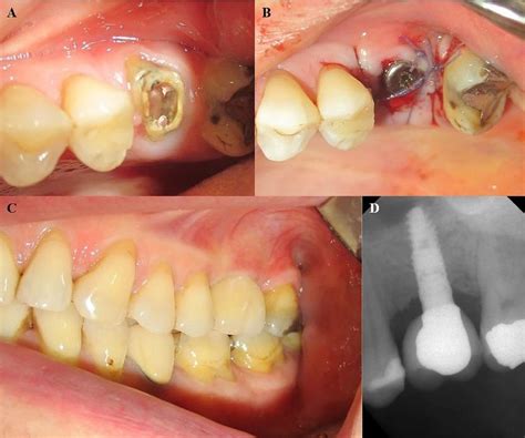 A Hopeless Maxillary First Molar Which Is Planned To Be Extracted Download Scientific